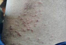 ရွာငံ မင်းပလောင်မှ စစ်ရှောင်များ ရေရှားပါးမှုကြုံနေရပြီး အရေပြားရောဂါဖြစ်