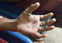 ဒီးမော့ဆို စစ်ရှောင်များ ရေရှားပါးမှုကြုံနေရ၊ ယားနာ အဖြစ်များလာ