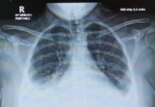 PM 2.5 ကြောင့် ပြင်းထန်အဆုတ်ရောဂါဖြစ်ပွားမှု မြှင့်တက်လာကြောင်း ချင်းမိုင်ဆရာဝန်သတိပေး